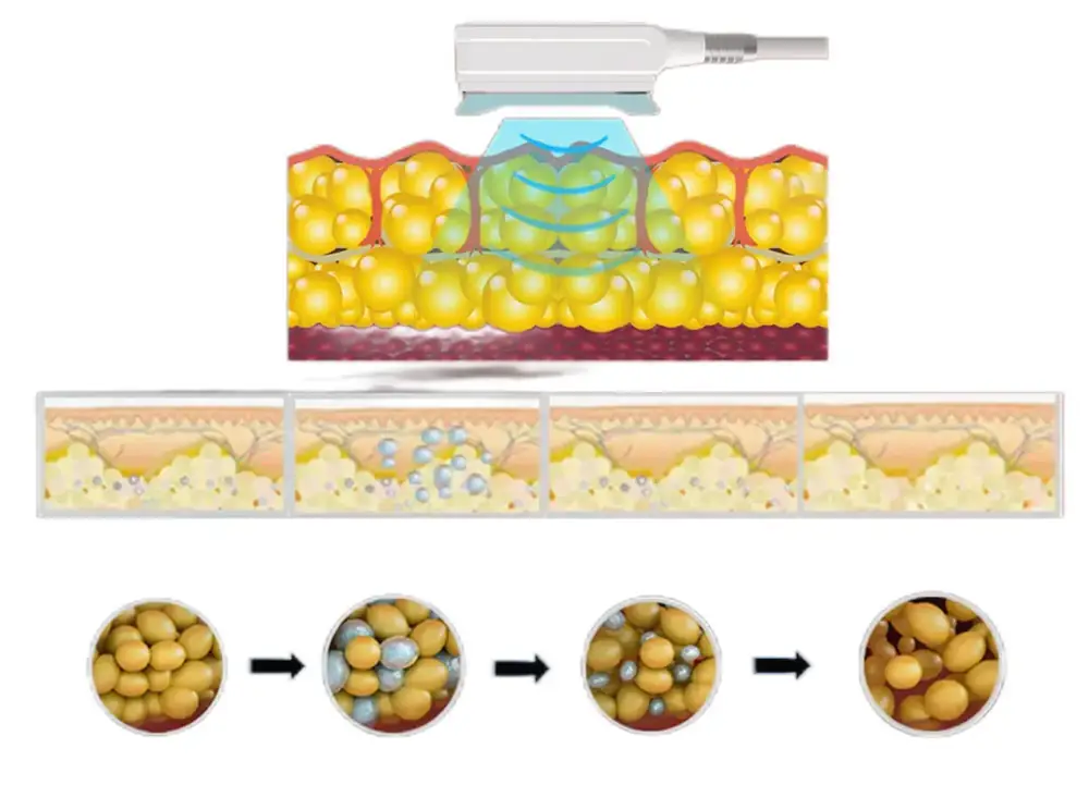 360°c cryolipolysis slimming system