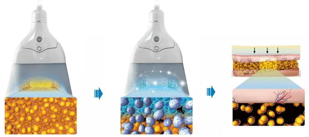 cryolipolysis slimming device 360°c cooling tech