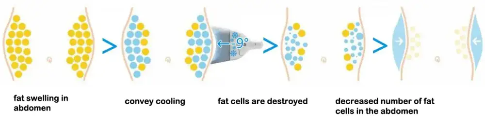 cryolipolysis slimming device 360°c cooling tech