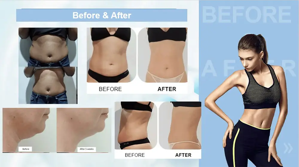 cryolipolysis slimming device 360°c cooling tech