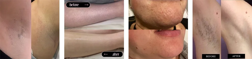 eon ice pro laser 3000w 808nm diode laser hair removal system