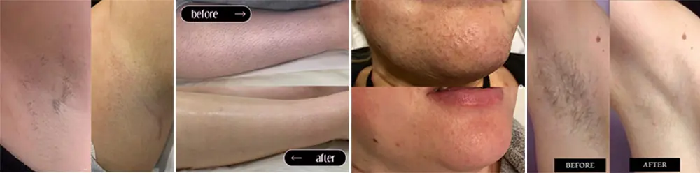 eon ice laser 1800w 808nm diode laser hair removal system