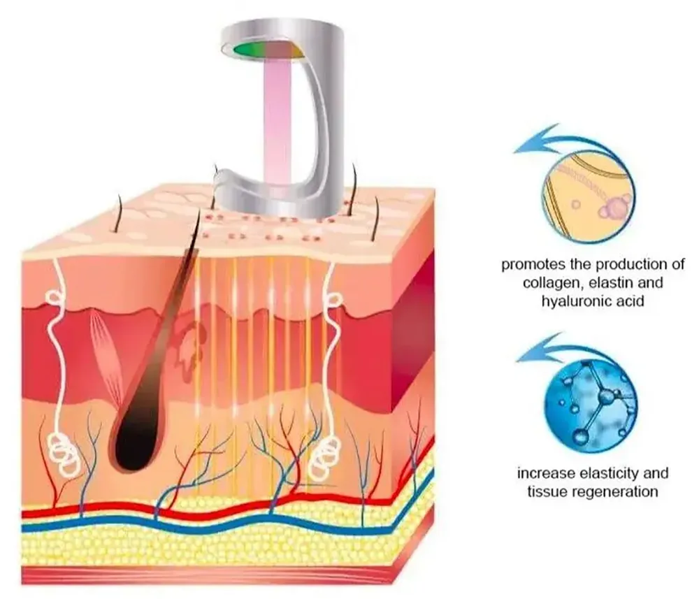 fraxre 10600nm fractional co2 laser 60w