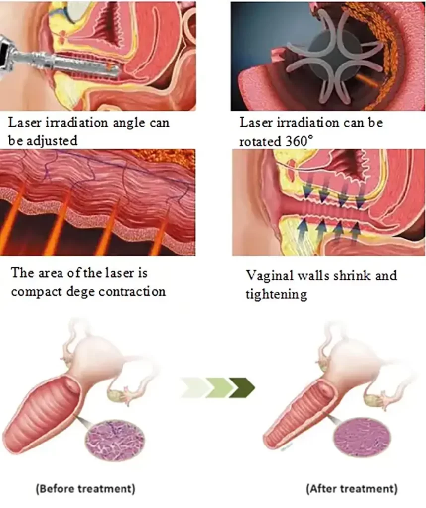 fraxre 10600nm fractional co2 laser 60w