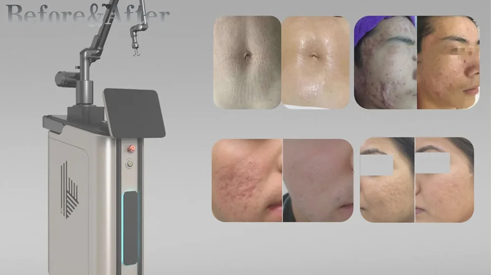 fraxre 10600nm fractional co2 laser 60w