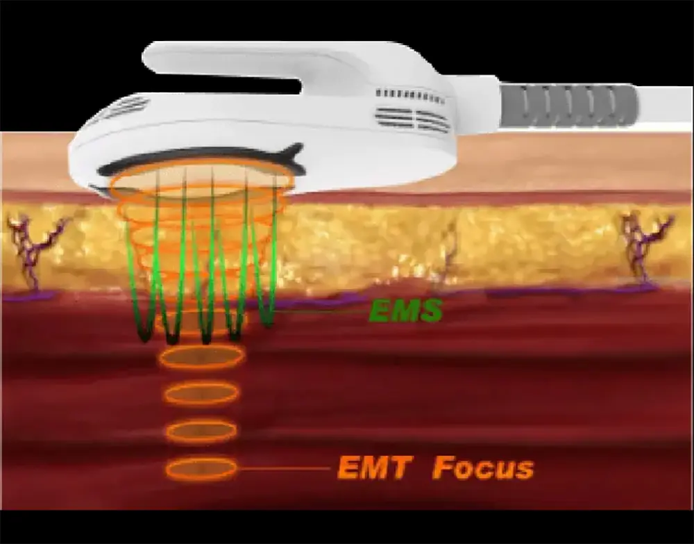hiemt emsculpting muscle building machine