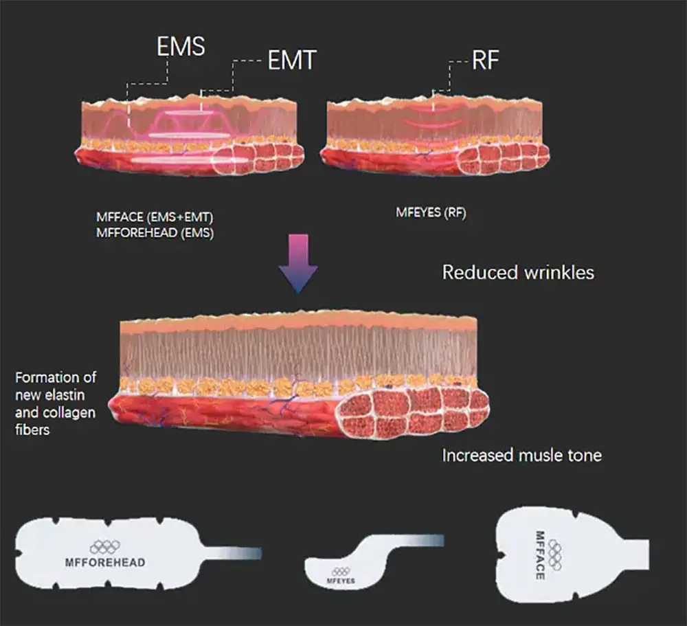 hilfes (high intensity low frequency electrical stimulation) + emt magnetic stimulation + precision