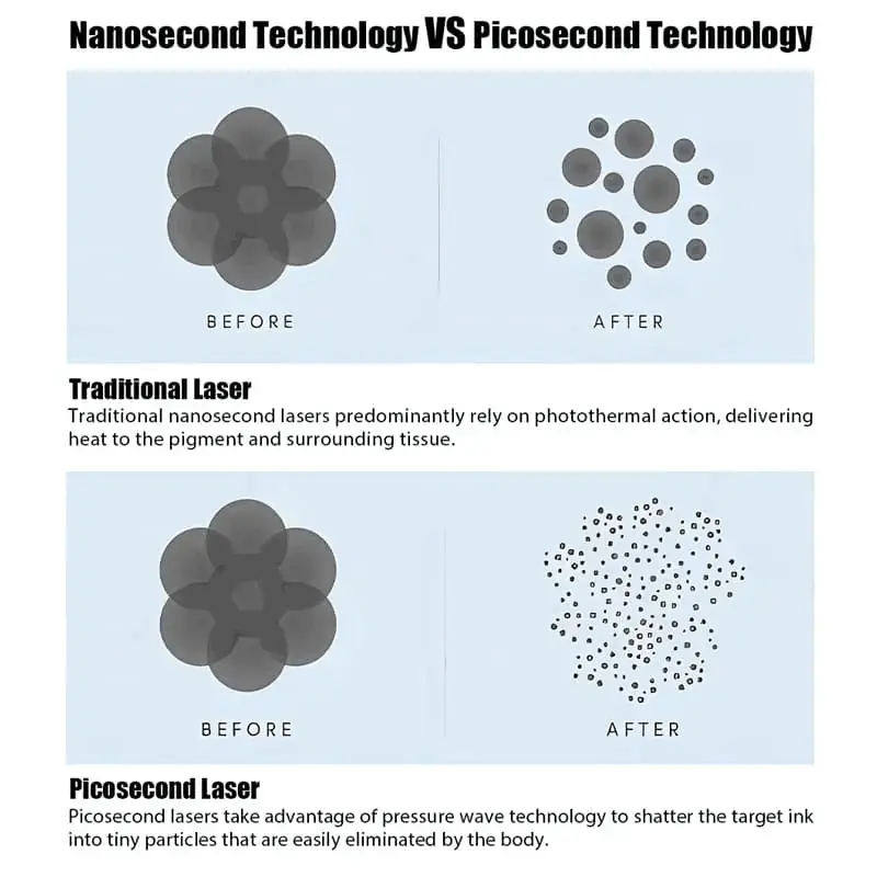 Introducing-the-revolutionary-Picosecond-Laser-Tattoo-Removal-Machine