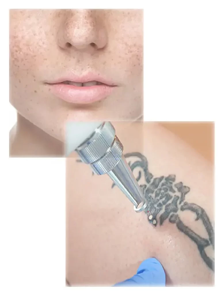 q switched nd yag laser device