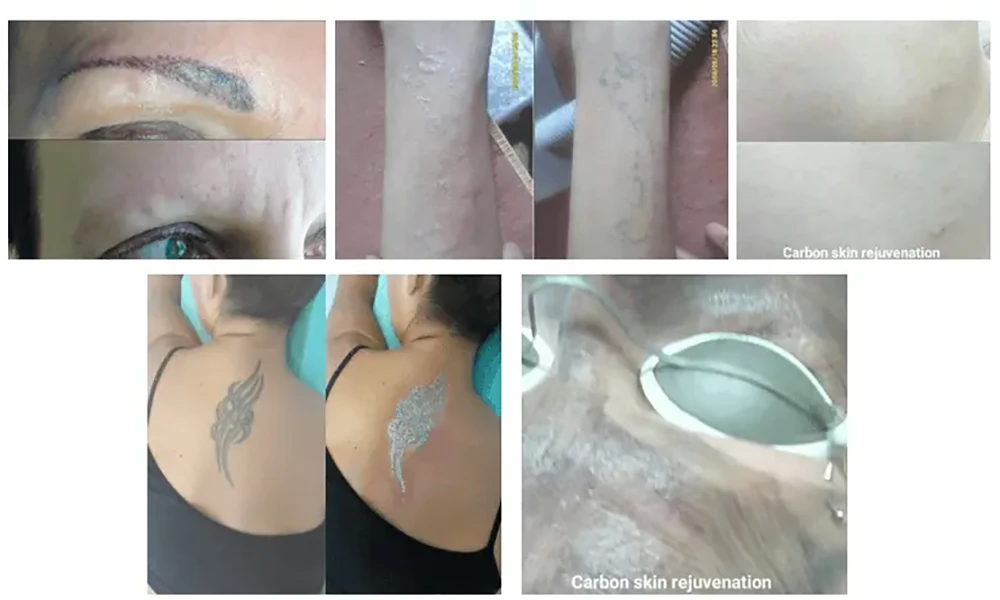 q switched nd yag laser device