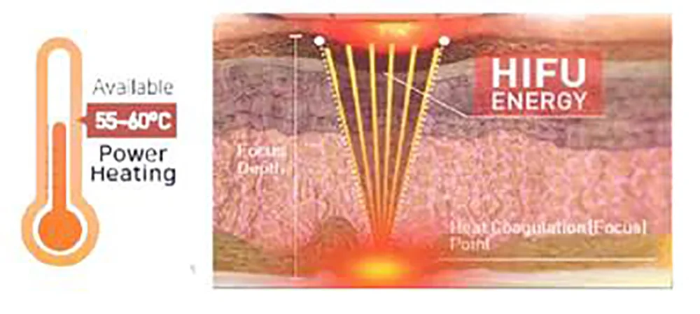 high energy focused ultrasound +focus rf 3d lifting