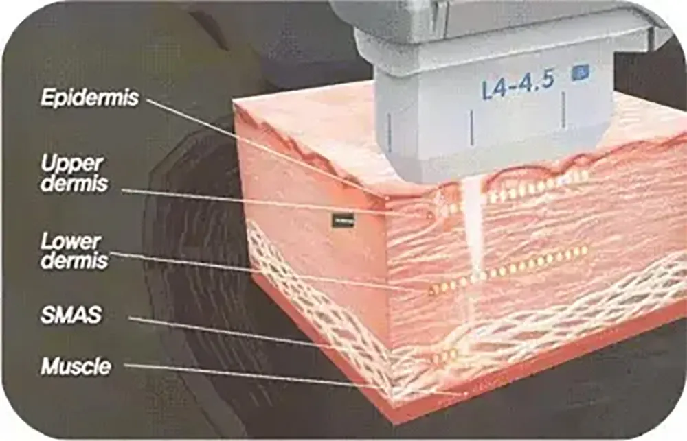 high energy focused ultrasound +focus rf 3d lifting