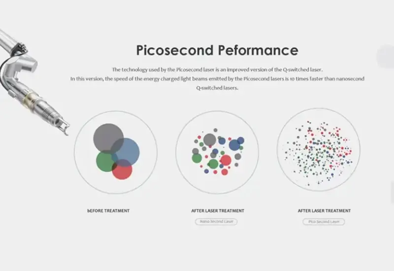 picosecond laser vs nanosecond laser performance before after treatment