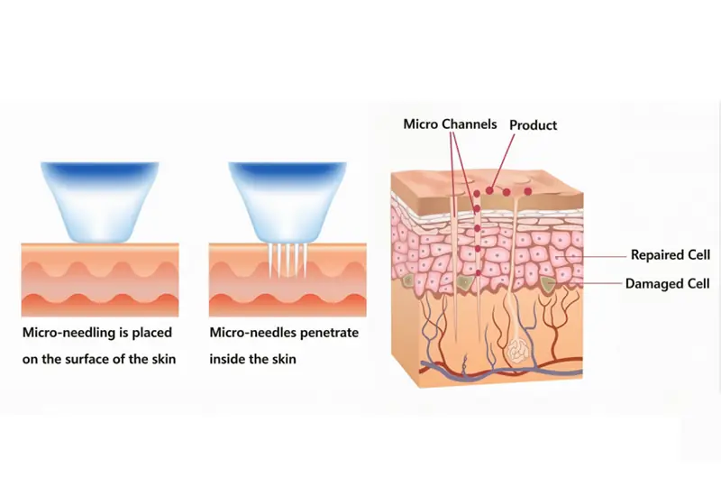 Why HM-MF-01 Golden Micro needling RF is Your Core Investment Alongside Diode, CO2, and Velashape Machines