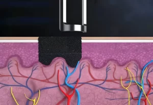 How Does PICOACE Picosecond Nd:YAG Laser Compare to Traditional Q-Switched Systems?