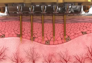 HIFU vs. Microneedle RF: The Best Skin Tightening Technology for Clinics