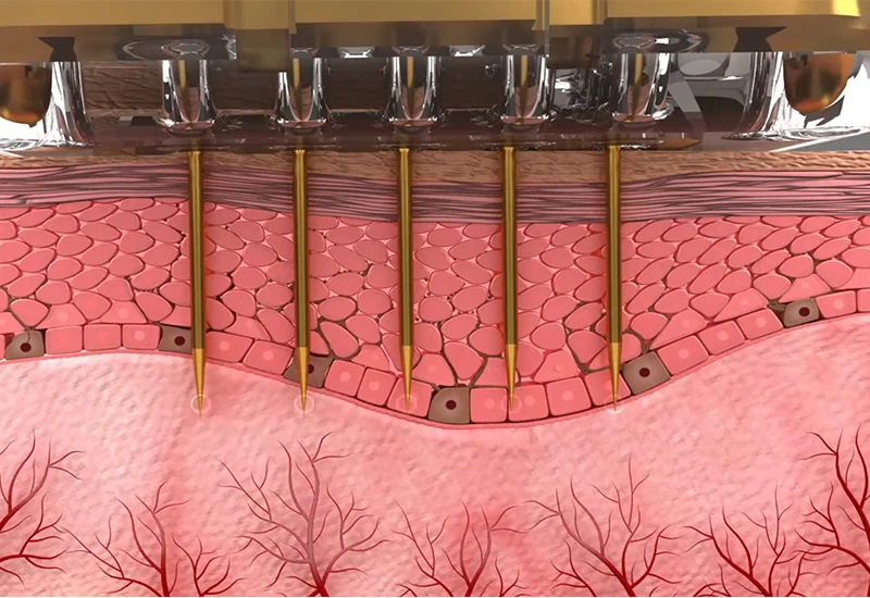 HIFU vs. Microneedle RF: The Best Skin Tightening Technology for Clinics