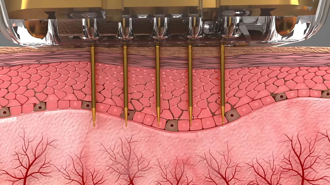 microneedle rf skin cross section working principle anatomy diagram
