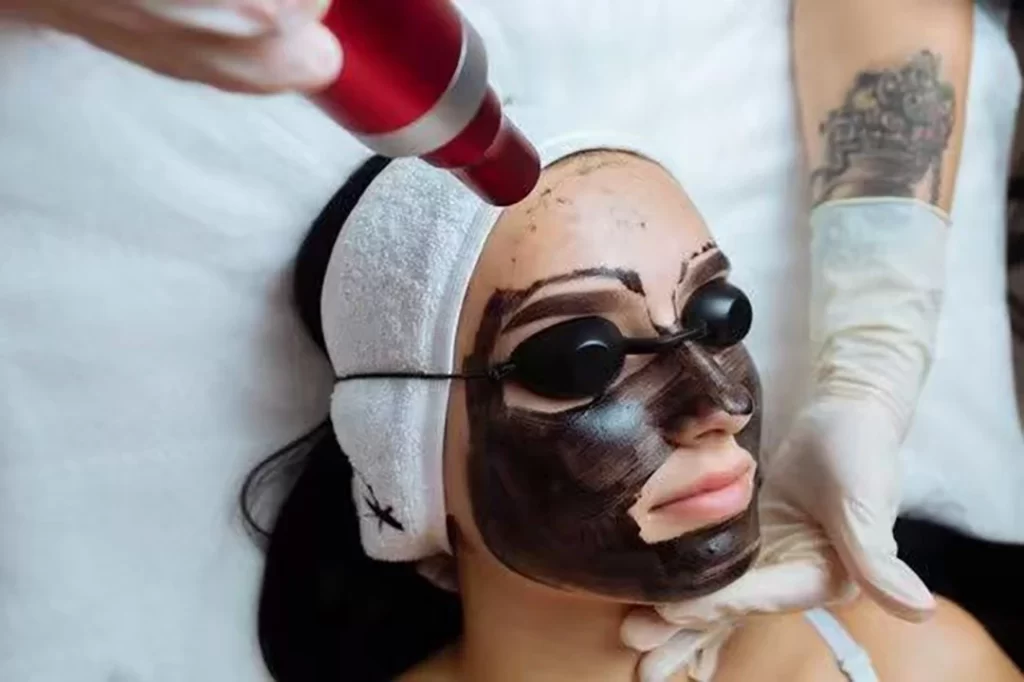 Practitioner conducting carbon peel laser facial treatment for skin rejuvenation and pore refinement in medspa