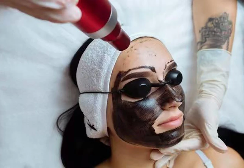 Carbon Peel Laser Treatment with Q-Switched Nd:YAG Laser: Technology, Benefits, and Clinical Applications